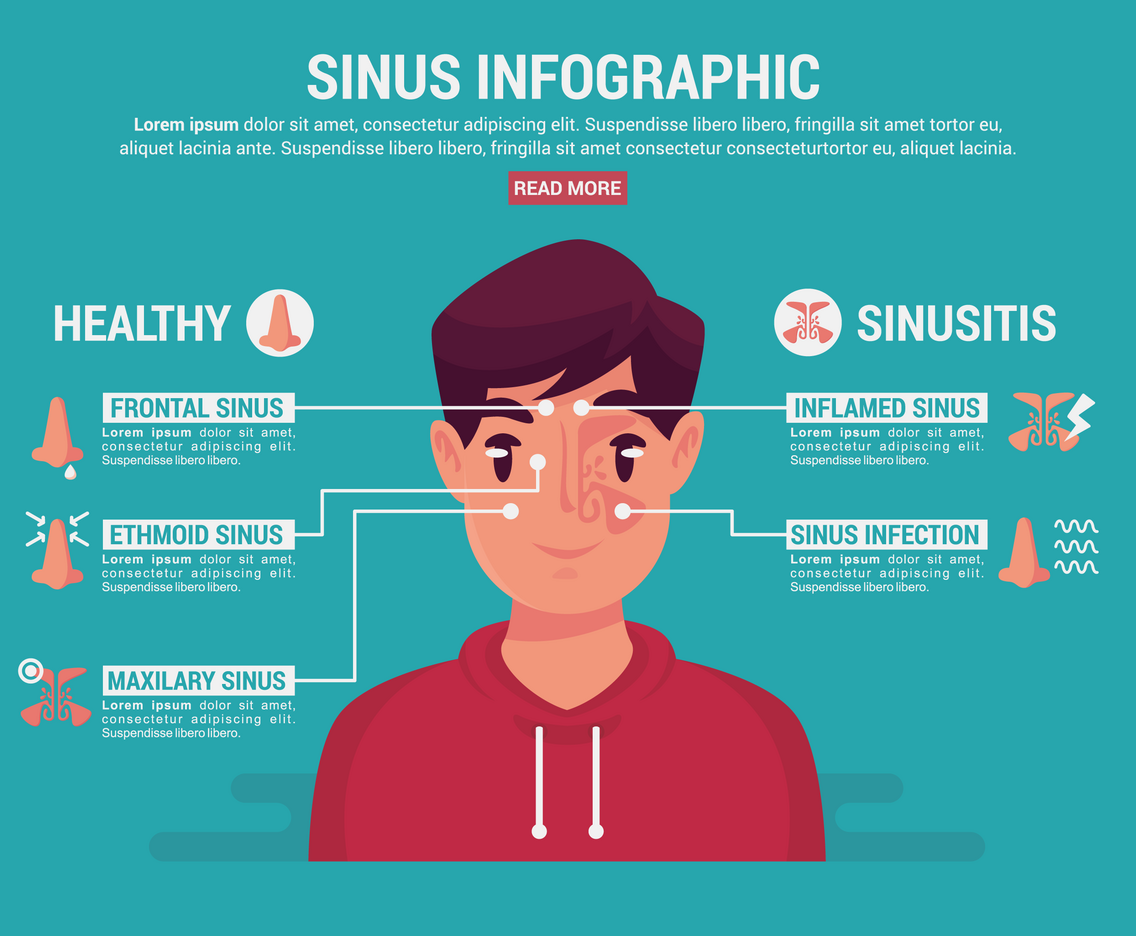 Sinus Infographic