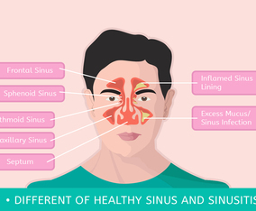 Different Of Healthy Sinus and Sinusitis