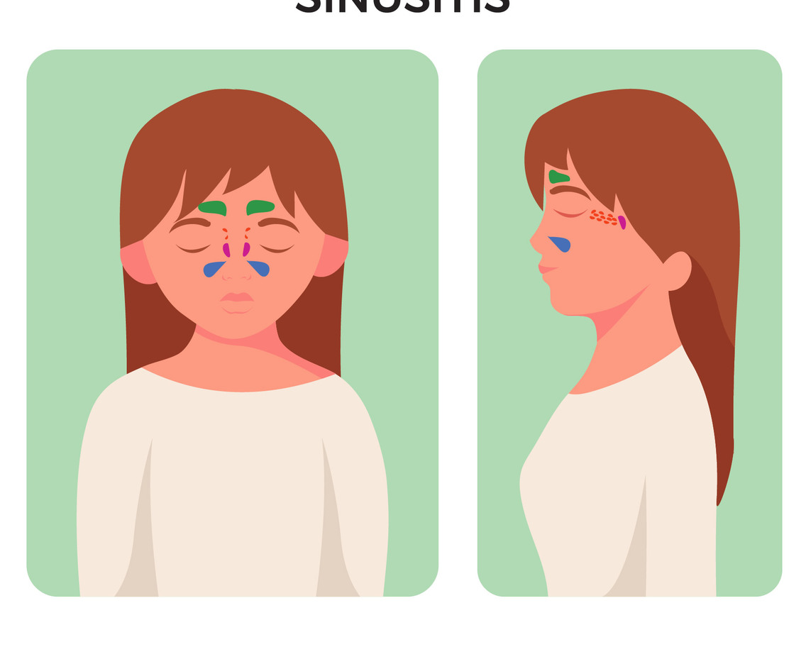 Sinusitis Disease Sinus Anatomy Illustration