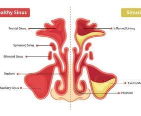 Healthy Sinus And Sinusitis