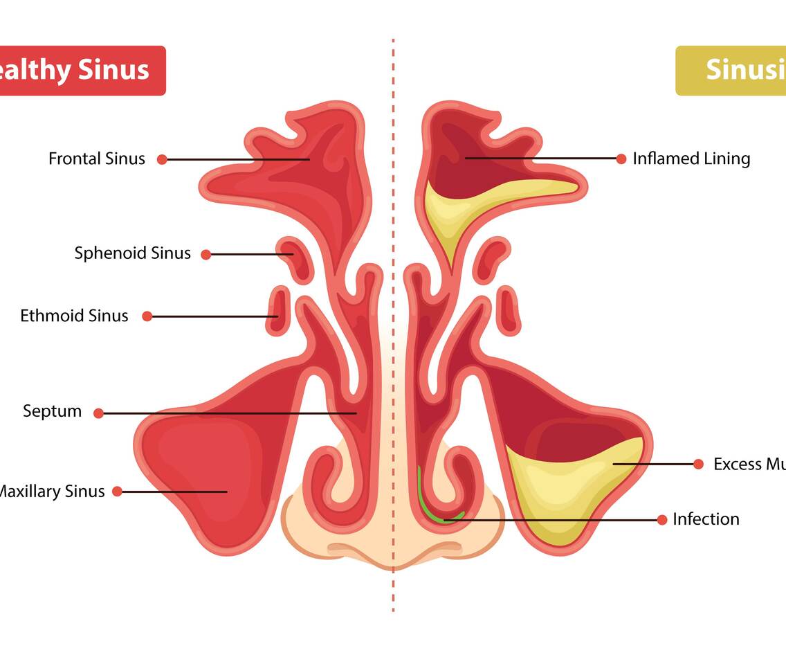 Healthy Sinus And Sinusitis