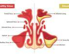 Healthy Sinus And Sinusitis