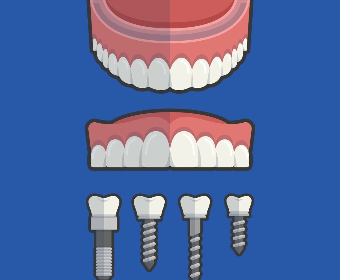 False Teeth With Screw Vector Illustration
