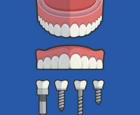 False Teeth With Screw Vector Illustration