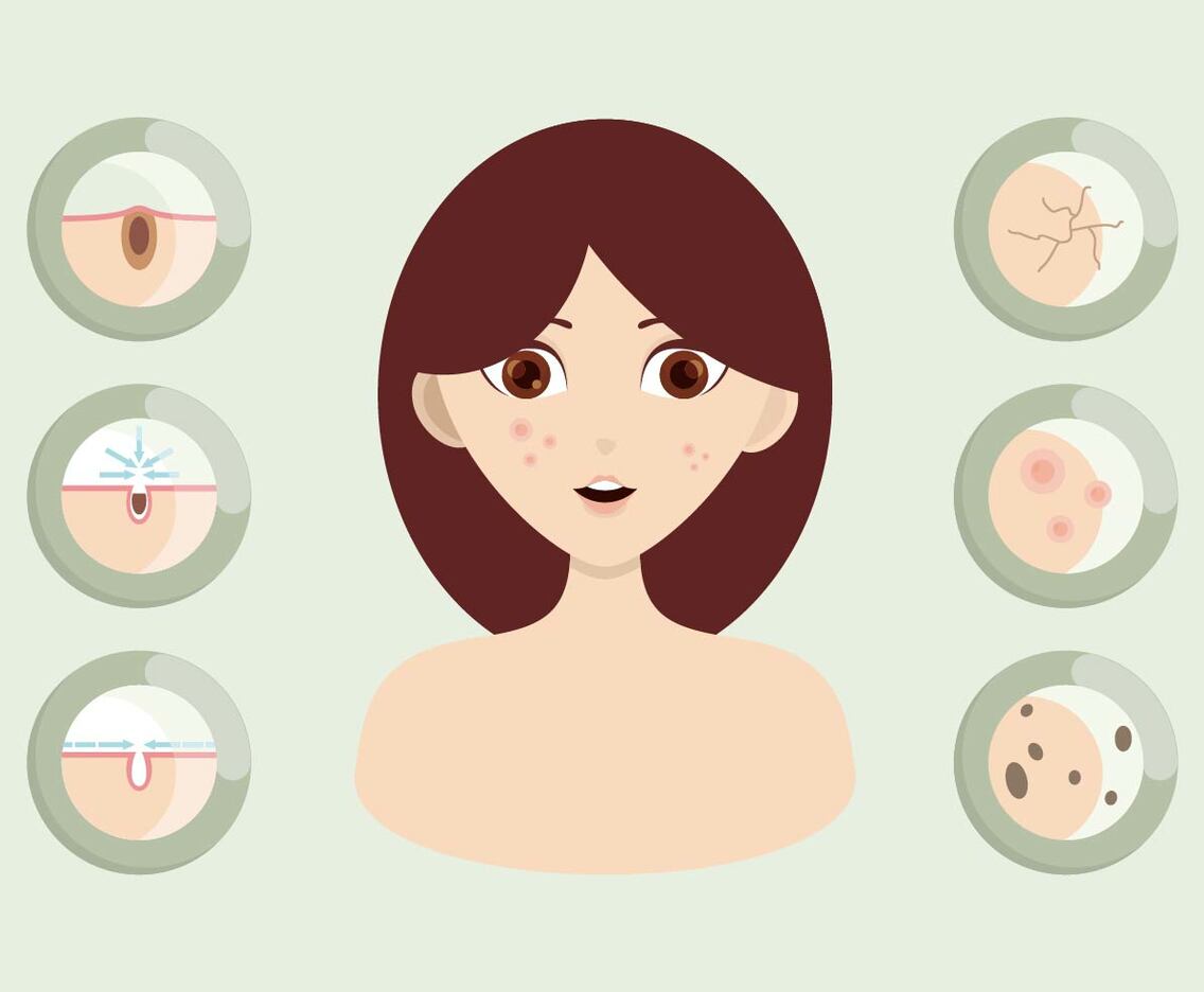 Pimple Illustration