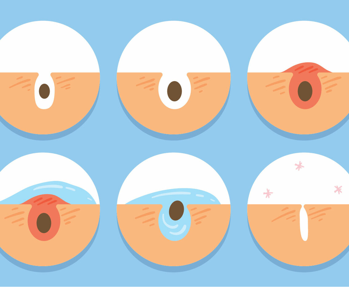 Pimple Icons Vector