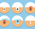 Pimple Icons Vector