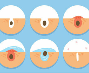 Pimple Icons Vector